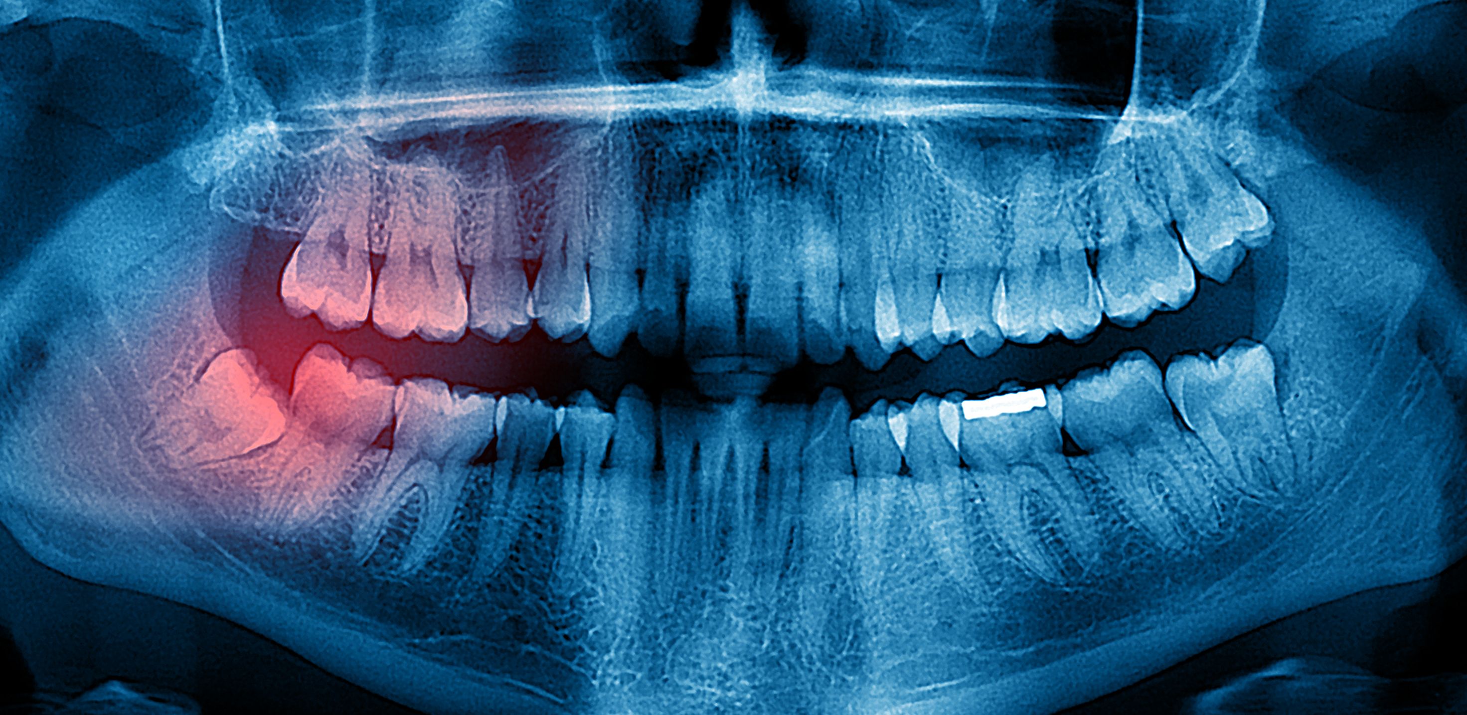 Рентген зуба, 3D КТ, панорамный снимок — в чем разница